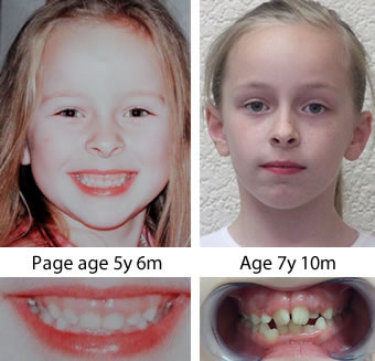 Facial development/ crooked teeth